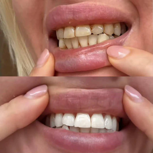 Charcoal PAP+ Teeth Whitening Strips