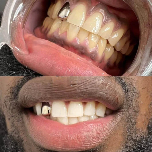 Charcoal PAP+ Teeth Whitening Strips